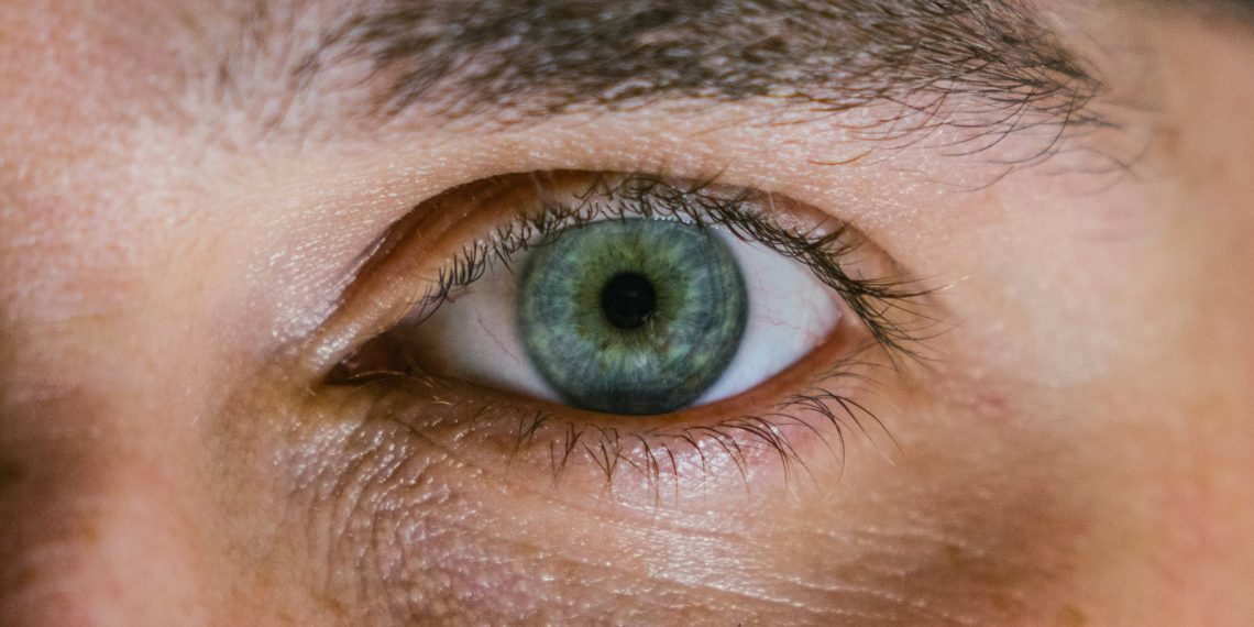 dark circles under eyes